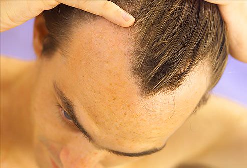 hombre con adelgazamiento del pelo